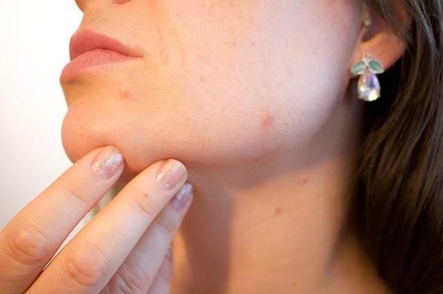 get rid of pimples overnight fast