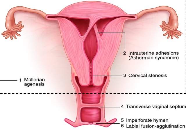 uterine synechiae