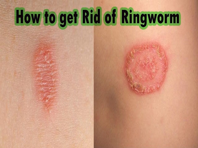 get rid of ringworm