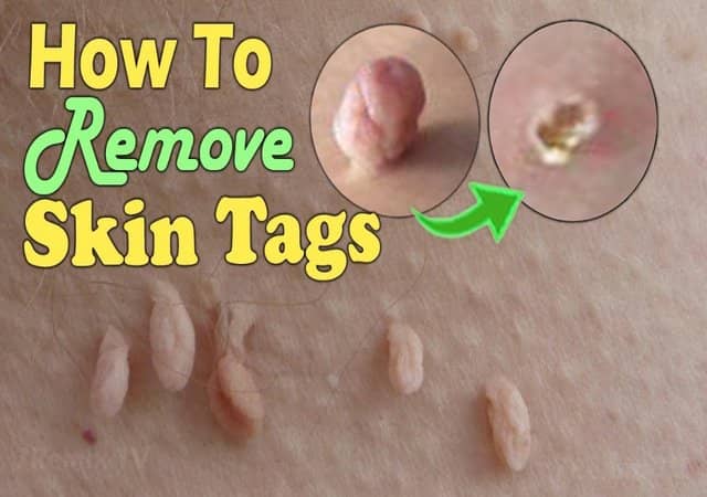 essential oils for skin tags